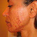 IPL burn marks